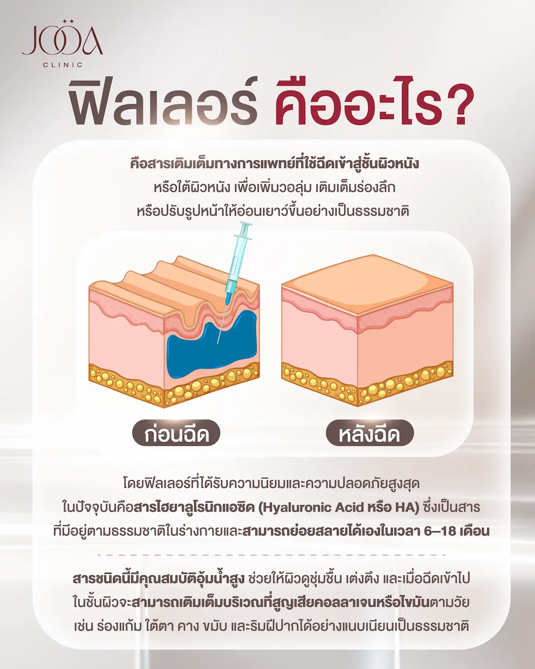 ฟิลเลอร์คืออะไร